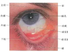 开云官网-疤痕眼睑退缩图片大全